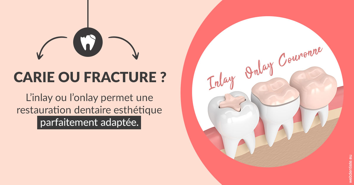 https://selarl-terre-de-sante.chirurgiens-dentistes.fr/T2 2023 - Carie ou fracture 2