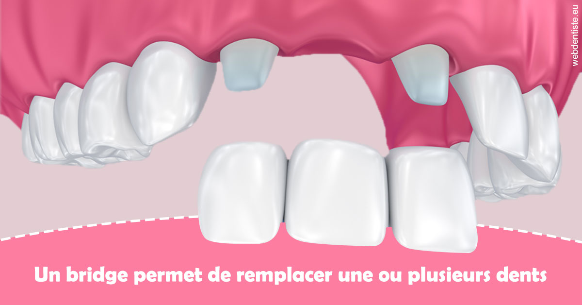 https://selarl-terre-de-sante.chirurgiens-dentistes.fr/Bridge remplacer dents 2