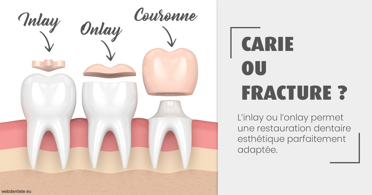 https://selarl-terre-de-sante.chirurgiens-dentistes.fr/T2 2023 - Carie ou fracture 1