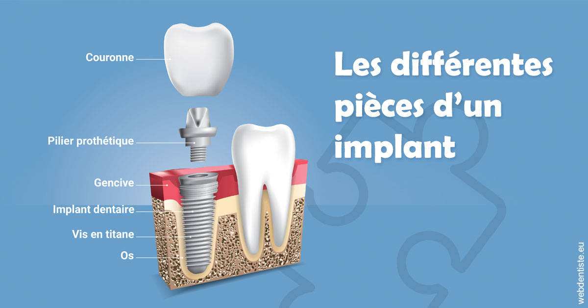 https://selarl-terre-de-sante.chirurgiens-dentistes.fr/Les différentes pièces d’un implant 1